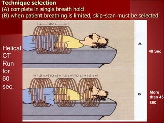 Technique selection
(A) complete in single breath hold
(B) when patient breathing is limited, skip-scan must be selected
40 Sec
More
than 45
sec
Helical
CT
Run
for
60
sec.
 