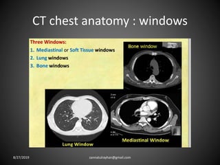 CT chest anatomy : windows
8/27/2019 zannatulrayhan@gmail.com
 