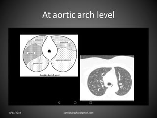 At aortic arch level
8/27/2019 zannatulrayhan@gmail.com
 