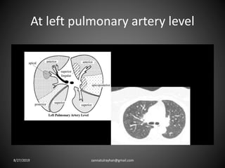 At left pulmonary artery level
8/27/2019 zannatulrayhan@gmail.com
 