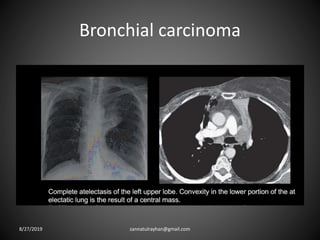Bronchial carcinoma
8/27/2019 zannatulrayhan@gmail.com
 