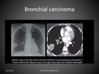 Bronchial carcinoma
8/27/2019 zannatulrayhan@gmail.com
 