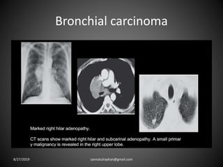 Bronchial carcinoma
8/27/2019 zannatulrayhan@gmail.com
 