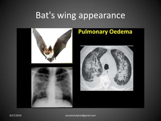 Bat's wing appearance
8/27/2019 zannatulrayhan@gmail.com
 