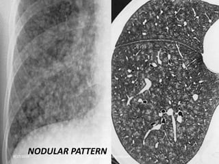 NODULAR PATTERN8/27/2019 zannatulrayhan@gmail.com
 