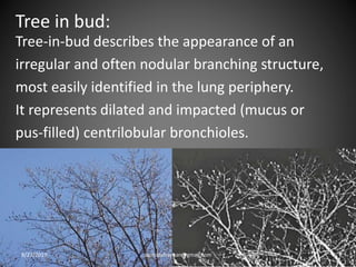 Tree in bud:
Tree-in-bud describes the appearance of an
irregular and often nodular branching structure,
most easily identified in the lung periphery.
It represents dilated and impacted (mucus or
pus-filled) centrilobular bronchioles.
8/27/2019 zannatulrayhan@gmail.com
 