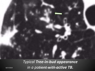 Typical Tree-in-bud appearance
in a patient with active TB.8/27/2019 zannatulrayhan@gmail.com
 