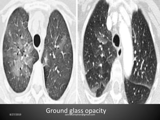 Ground glass opacity8/27/2019 zannatulrayhan@gmail.com
 