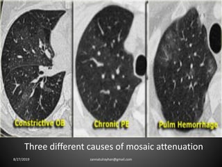 Three different causes of mosaic attenuation
8/27/2019 zannatulrayhan@gmail.com
 