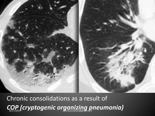 Chronic consolidations as a result of
COP (cryptogenic organizing pneumonia)8/27/2019 zannatulrayhan@gmail.com
 