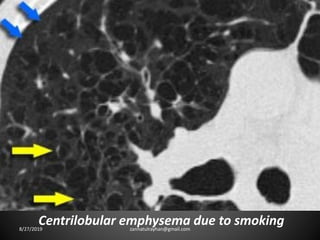 Centrilobular emphysema due to smoking8/27/2019 zannatulrayhan@gmail.com
 