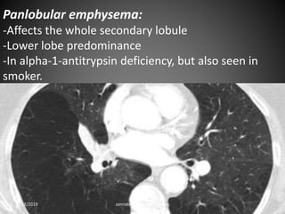 Panlobular emphysema:
-Affects the whole secondary lobule
-Lower lobe predominance
-In alpha-1-antitrypsin deficiency, but also seen in
smoker.
8/27/2019 zannatulrayhan@gmail.com
 