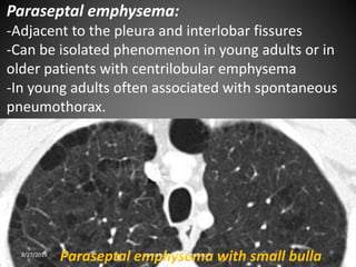 Paraseptal emphysema:
-Adjacent to the pleura and interlobar fissures
-Can be isolated phenomenon in young adults or in
older patients with centrilobular emphysema
-In young adults often associated with spontaneous
pneumothorax.
Paraseptal emphysema with small bulla8/27/2019 zannatulrayhan@gmail.com
 