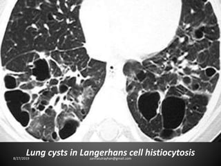 Lung cysts in Langerhans cell histiocytosis8/27/2019 zannatulrayhan@gmail.com
 