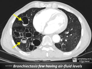 Bronchiectasis few having air-fluid levels8/27/2019 zannatulrayhan@gmail.com
 