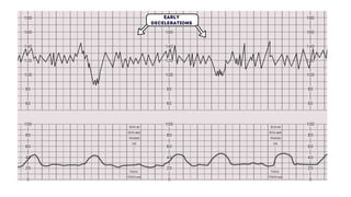 BASICS OF CTG MONITORING INTERPRETATION.pptx