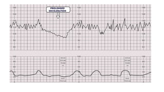 BASICS OF CTG MONITORING INTERPRETATION.pptx