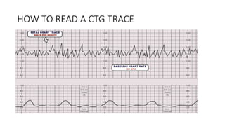 BASICS OF CTG MONITORING INTERPRETATION.pptx