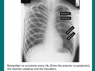Basics Of CXR interpretation www.radiologydefinition.com