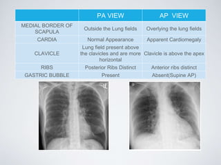PA VIEW AP VIEW
MEDIAL BORDER OF
SCAPULA
Outside the Lung fields Overlying the lung fields
CARDIA Normal Appearance Apparent Cardiomegaly
CLAVICLE
Lung field present above
the clavicles and are more
horizontal
Clavicle is above the apex
RIBS Posterior Ribs Distinct Anterior ribs distinct
GASTRIC BUBBLE Present Absent(Supine AP)
 