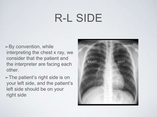R-L SIDE
➢By convention, while
interpreting the chest x ray, we
consider that the patient and
the interpreter are facing each
other.
➢The patient’s right side is on
your left side, and the patient’s
left side should be on your
right side
RIGHT LEFT
 