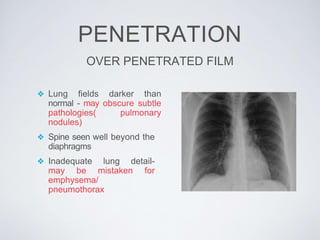 PENETRATION
OVER PENETRATED FILM
❖ Lung fields darker than
normal - may obscure subtle
pathologies( pulmonary
nodules)
❖ Spine seen well beyond the
diaphragms
❖ Inadequate lung detail-
may be mistaken for
emphysema/
pneumothorax
 