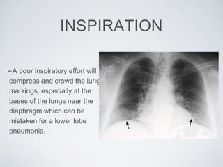 INSPIRATION
➢A poor inspiratory effort will
compress and crowd the lung
markings, especially at the
bases of the lungs near the
diaphragm which can be
mistaken for a lower lobe
pneumonia.
 