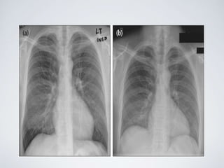 GOOD INSPIRATORY FILM
 