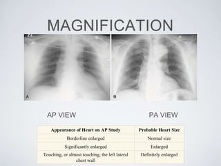 MAGNIFICATION
AP VIEW PA VIEW
Appearance of Heart on AP Study Probable Heart Size
Borderline enlarged Normal size
Significantly enlarged Enlarged
Touching, or almost touching, the left lateral
chest wall
Definitely enlarged
 