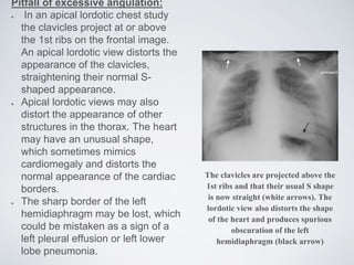 Pitfall of excessive angulation:
In an apical lordotic chest study
the clavicles project at or above
the 1st ribs on the frontal image.
An apical lordotic view distorts the
appearance of the clavicles,
straightening their normal S-
shaped appearance.
Apical lordotic views may also
distort the appearance of other
structures in the thorax. The heart
may have an unusual shape,
which sometimes mimics
cardiomegaly and distorts the
normal appearance of the cardiac
borders.
The sharp border of the left
hemidiaphragm may be lost, which
could be mistaken as a sign of a
left pleural effusion or left lower
lobe pneumonia.
The clavicles are projected above the
1st ribs and that their usual S shape
is now straight (white arrows). The
lordotic view also distorts the shape
of the heart and produces spurious
obscuration of the left
hemidiaphragm (black arrow)
 