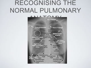 RECOGNISING THE
NORMAL PULMONARY
ANATOMY
 