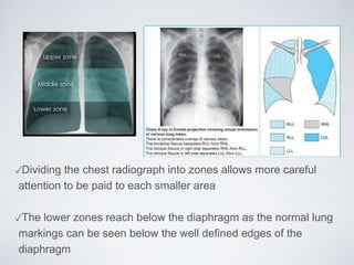 ✓Dividing the chest radiograph into zones allows more careful
attention to be paid to each smaller area
✓The lower zones reach below the diaphragm as the normal lung
markings can be seen below the well defined edges of the
diaphragm
 