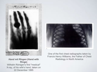 Hand mit Ringen (Hand with
Rings)
Wilhelm Röntgen's first "medical"
X-ray, of his wife's hand, taken on
22 December 1895
One of the first chest radiographs taken by
Francis Henry Williams, the Father of Chest
Radiology in North America
 