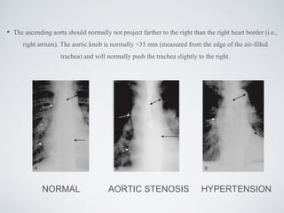• The ascending aorta should normally not project farther to the right than the right heart border (i.e.,
right atrium). The aortic knob is normally <35 mm (measured from the edge of the air-filled
trachea) and will normally push the trachea slightly to the right.
NORMAL AORTIC STENOSIS HYPERTENSION
 