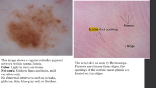 Basics of Dermoscopy seminar by dr akshata soni | PPTX