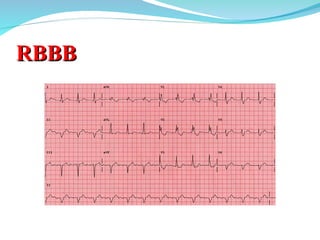 The basics of ECG and its interpretation | PPT