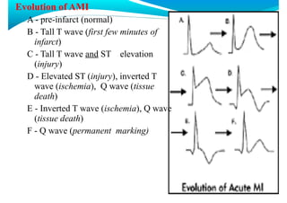Myocardial infarction and its management | PDF