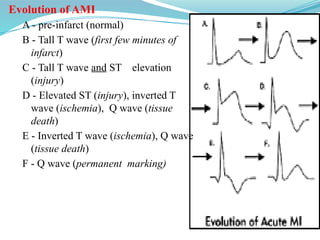 Evolution of AMI
A - pre-infarct (normal)
B - Tall T wave (first few minutes of
infarct)
C - Tall T wave and ST elevation
(injury)
D - Elevated ST (injury), inverted T
wave (ischemia), Q wave (tissue
death)
E - Inverted T wave (ischemia), Q wave
(tissue death)
F - Q wave (permanent marking)
 