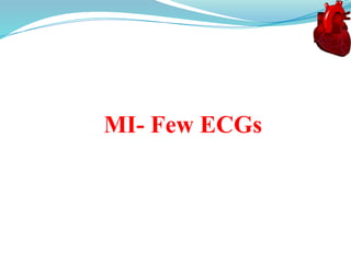 MI- Few ECGs
 
