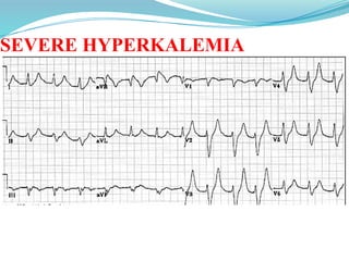 SEVERE HYPERKALEMIA
 