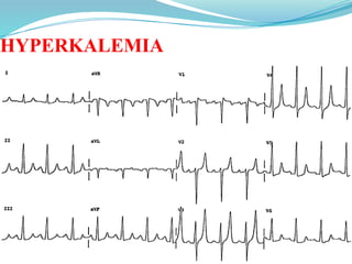 HYPERKALEMIA
 