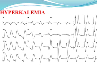 HYPERKALEMIA
 