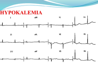 HYPOKALEMIA
 