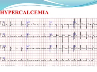 HYPERCALCEMIA
 