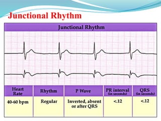 Junctional Rhythm
 