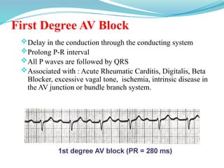 First Degree AV Block
Delay in the conduction through the conducting system
Prolong P-R interval
All P waves are followed by QRS
Associated with : Acute Rheumatic Carditis, Digitalis, Beta
Blocker, excessive vagal tone, ischemia, intrinsic disease in
the AV junction or bundle branch system.
 