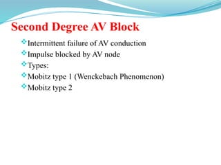 Second Degree AV Block
Intermittent failure of AV conduction
Impulse blocked by AV node
Types:
Mobitz type 1 (Wenckebach Phenomenon)
Mobitz type 2
 
