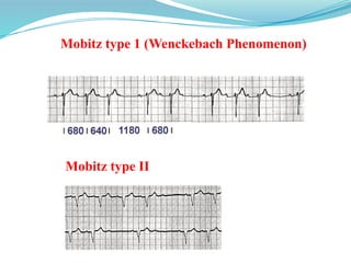 Mobitz type 1 (Wenckebach Phenomenon)
Mobitz type II
 