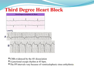 Third Degree Heart Block
CHB evidenced by the AV dissociation
A junctional escape rhythm at 45 bpm.
The PP intervals vary because of ventriculophasic sinus arrhythmia;
 