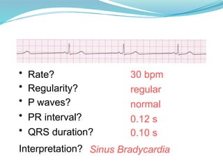 30 bpm
• Rate?
• Regularity? regular
normal
0.10 s
• P waves?
• PR interval? 0.12 s
• QRS duration?
Interpretation? Sinus Bradycardia
 